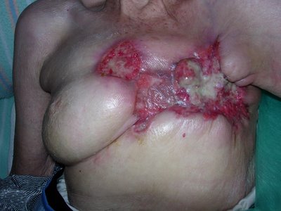 carcinoma infiltrante da mama